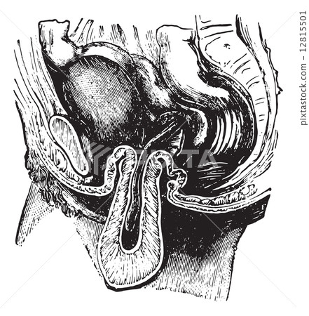 Reversal or inversion of the uterus, vintage engraving. 12815501