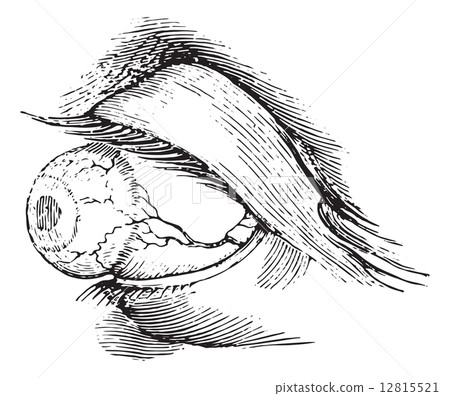 Total anterior staphyloma, vintage engraving. Total anterior staphyloma, vintage engraving. 12815521