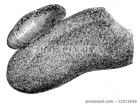 Angioma of the Human Tongue, vintage engraving 12815648