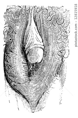 Hypertrophy of the clitoris simulating gland of man and can make Hypertrophy of the clitoris simulating gland of man and can make 12815918