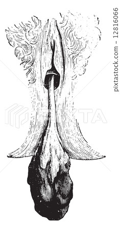 Cervical polyp, vintage engraving. Cervical polyp, vintage engraving. 12816066