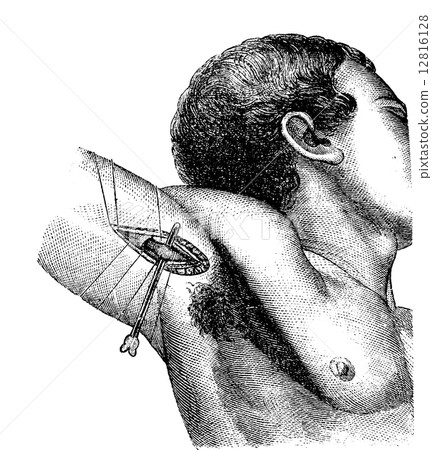 Axillary artery ligation in the armpit, vintage engraving. Axillary artery ligation in the armpit, vintage engraving. 12816128