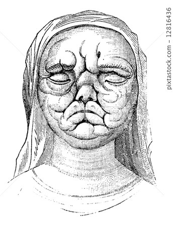 Leprosy or Hansen's Disease, vintage engraving 12816436