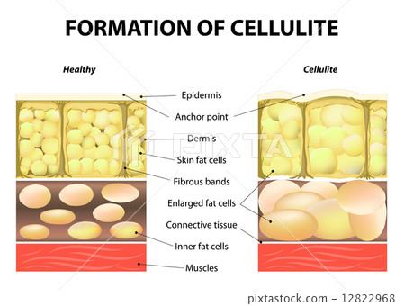 Formation of cellulite 12822968