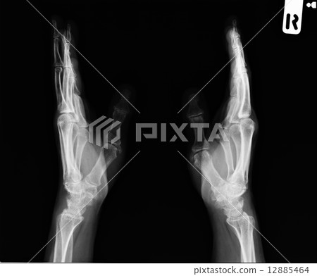 X-ray of the hands 12885464