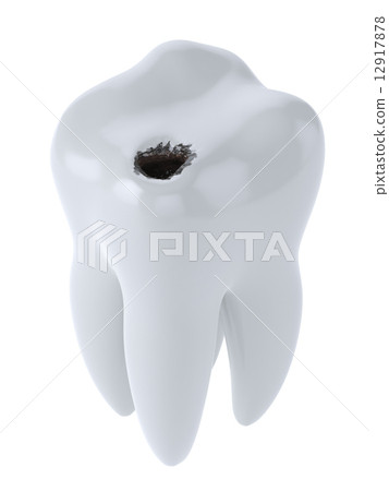 Tooth with black hole caries Tooth with black hole caries 12917878