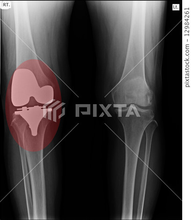 knee and knee with total replacement x-ray image knee and knee with total replacement x-ray image 12984261