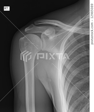 X-ray of human shoulder 12985089