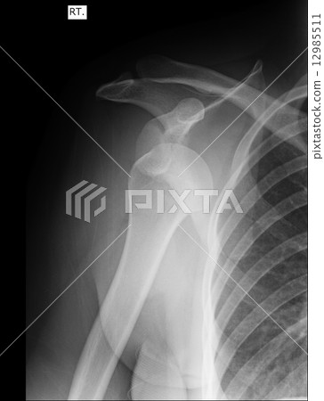 X-ray of human shoulder X-ray of human shoulder 12985511