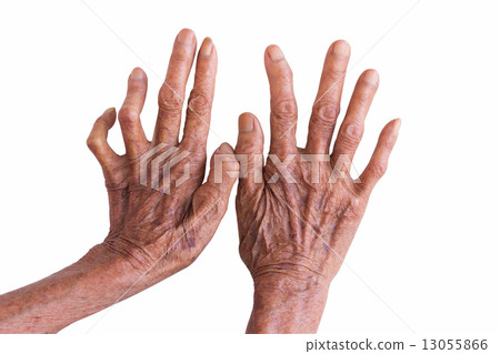 hands of a leprosy isolated on white background 13055866