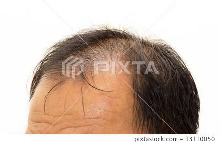 Male head with hair loss symptoms front side 13110050