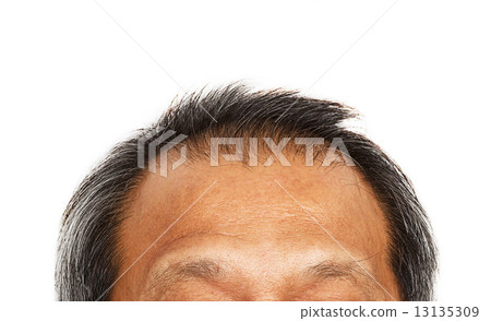 Hair loss , Male head with hair loss symptoms 13135309