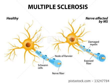 Multiple Sclerosis 13247784