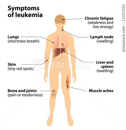 symptoms of  leukemia. blood cancer 13357503