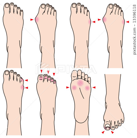 Foot trouble 13396118