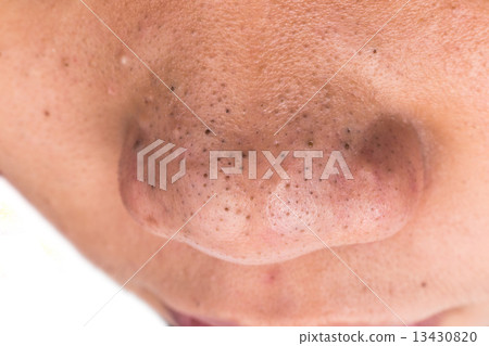 Closed-up of pimple blackheads on the nose Closed-up of pimple blackheads on the nose 13430820