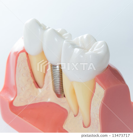 Dental implant Dental implant 13473717
