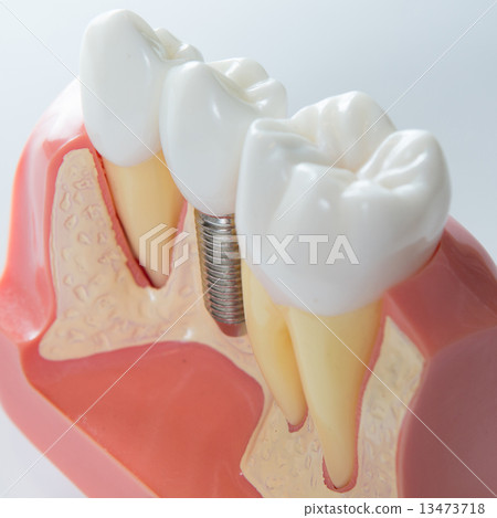 Dental implant 13473718