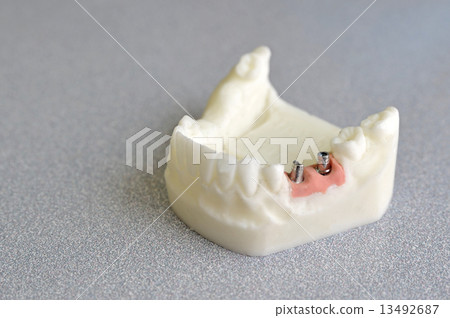 Dental tooth implants 13492687