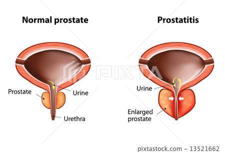 Prostatitis 13521662