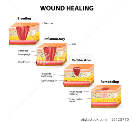 wound healing wound healing 13528770