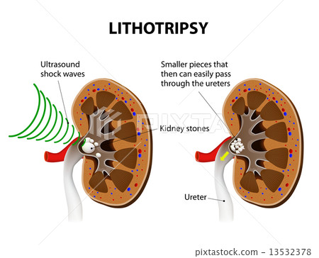 lithotripsy lithotripsy 13532378