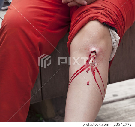Broken bone 13541772
