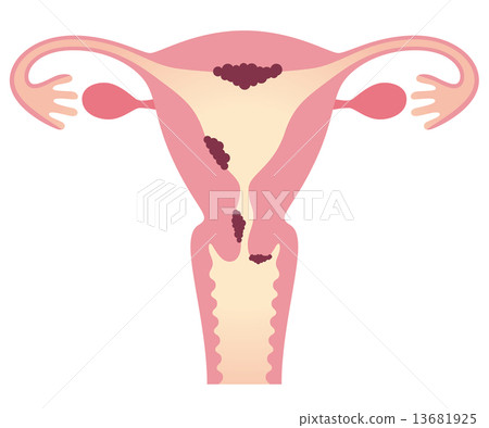 Uterine cancer Women's body Uterine cancer Women's body 13681925