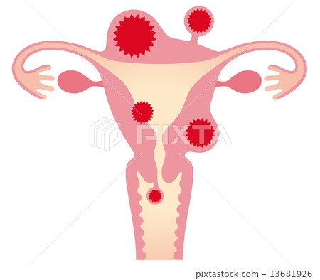 Uterine myomas Female body - Stock Illustration [13681926] - PIXTA
