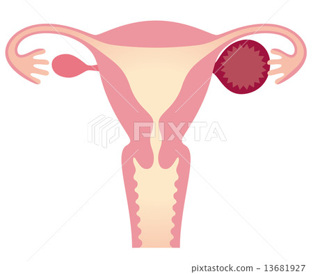 卵巢囊腫女性體 13681927