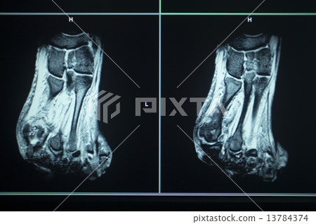 MRI scan test results foot toes injury MRI scan test results foot toes injury 13784374