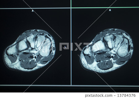 MRI scan test results foot toes injury MRI scan test results foot toes injury 13784376