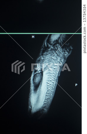 MRI scan test results foot toes injury MRI scan test results foot toes injury 13784384
