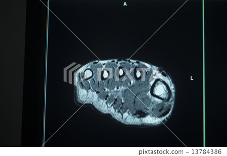 MRI scan test results foot toes injury MRI scan test results foot toes injury 13784386