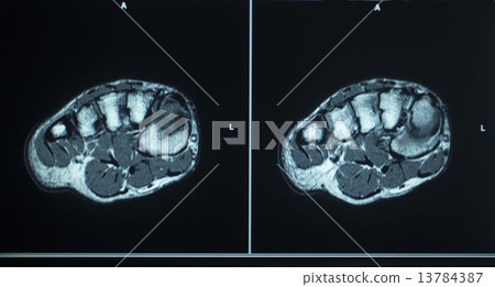 MRI scan test results foot toes injury MRI scan test results foot toes injury 13784387