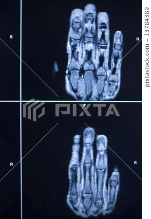MRI scan test results hand finger injury MRI scan test results hand finger injury 13784389
