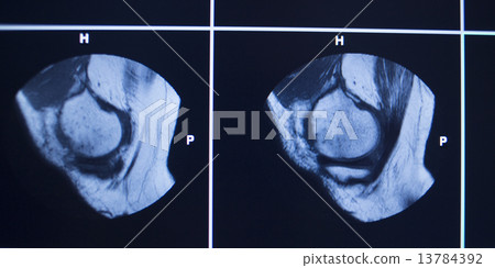 MRI scan test results knee meniscus injury MRI scan test results knee meniscus injury 13784392