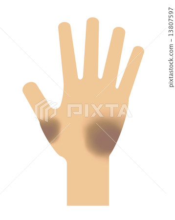 Bruise of hands Bruise of hands 13807597