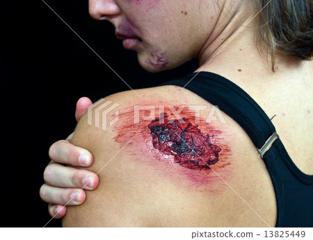 open wound on woman shoulder 13825449