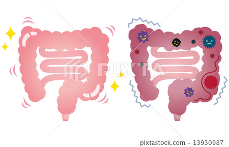 Colon colon cancer of healthy colon disease Colon colon cancer of healthy colon disease 13930987