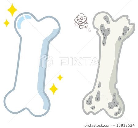 Healthy bones and weak bones 13932524