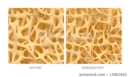 Osteoporosis 13962681