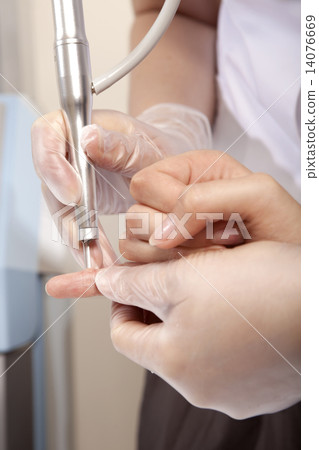 laser ramoval of wart 14076669