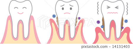 Periodontal disease 14131403