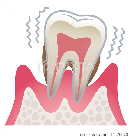 Sectional view of teeth Periodontal disease 14170670
