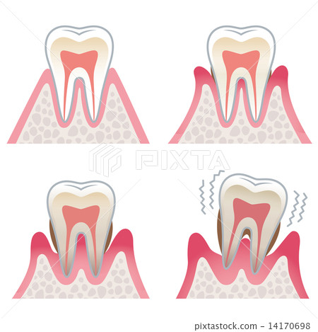 牙齒牙周病的剖面圖 14170698