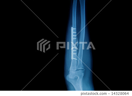 fracture forearm with  internal fixed by plate and screw 14328064