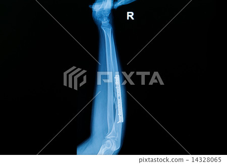 fracture forearm with  internal fixed by plate and screw 14328065