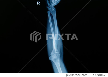 Film x-ray forearm fracture 14328067