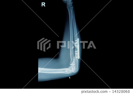 Film x-ray wrist fracture 14328068